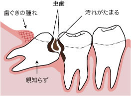 em炸